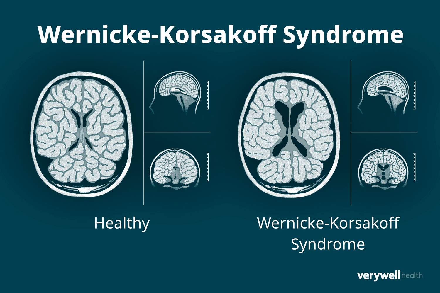 'Sindroma Korsakoff: Kur mungesa e vitaminës shkatërron kujtesën'