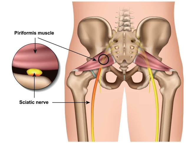 SINDROMA PIRIFORMIS