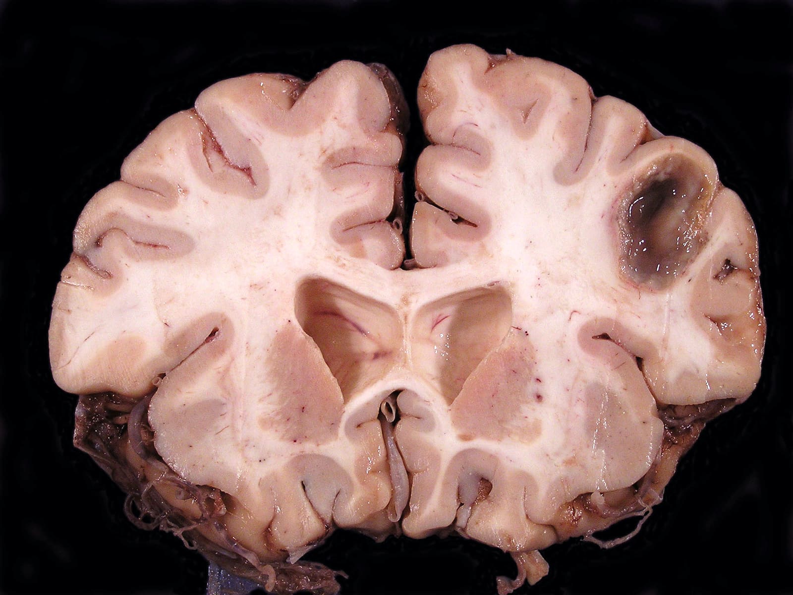 Abcesi cerebral nga Klebsiella dhe evolucioni i “heterovirulencës” në traktin urinar